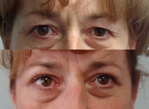 Upper blepharoplasty, after 3 weeks